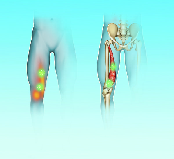 Patellaspitzen Syndrom  (Jumper´s Knee)